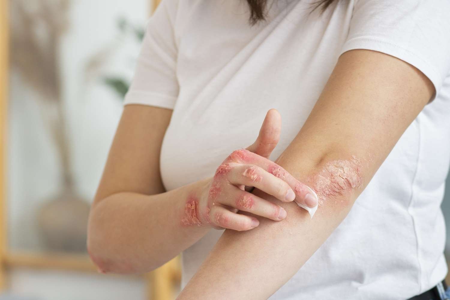 patient suffering from eczema