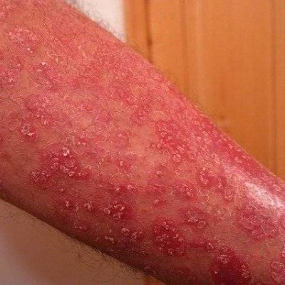 inflammed psoriasis on leg