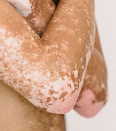 vitiligo-arms